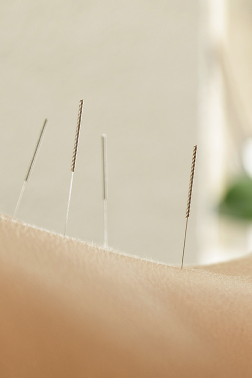 acupuncture